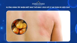 dị ứng hành tây