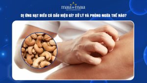 dị ứng hạt điều