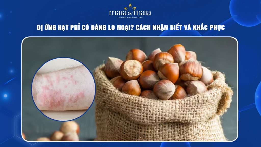 dị ứng hạt phỉ