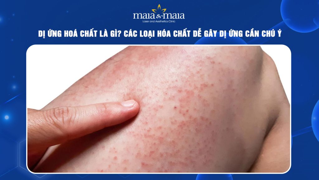 Dị ứng hoá chất