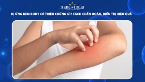 dị ứng kem body
