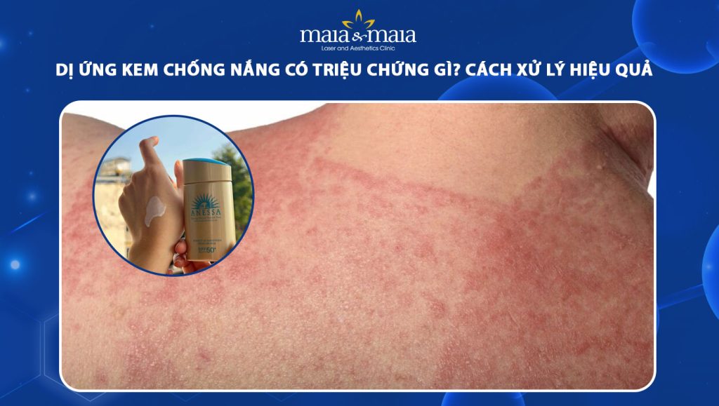 dị ứng kem chống nắng