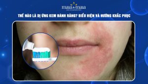 Dị ứng kem đánh răng
