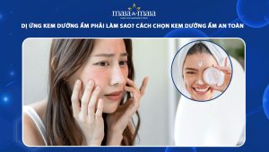 dị ứng kem dưỡng ẩm
