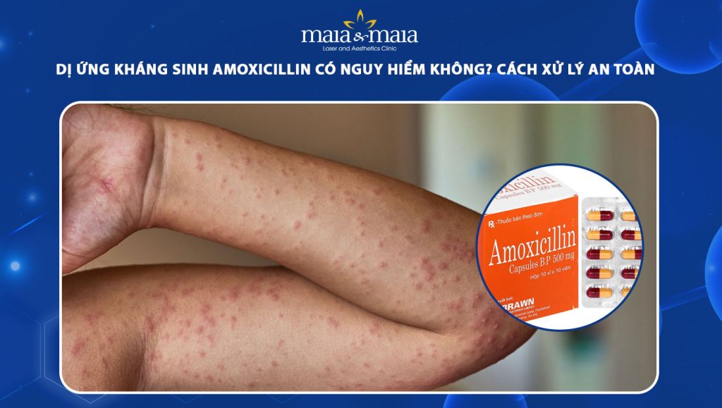 dị ứng kháng sinh amoxicillin