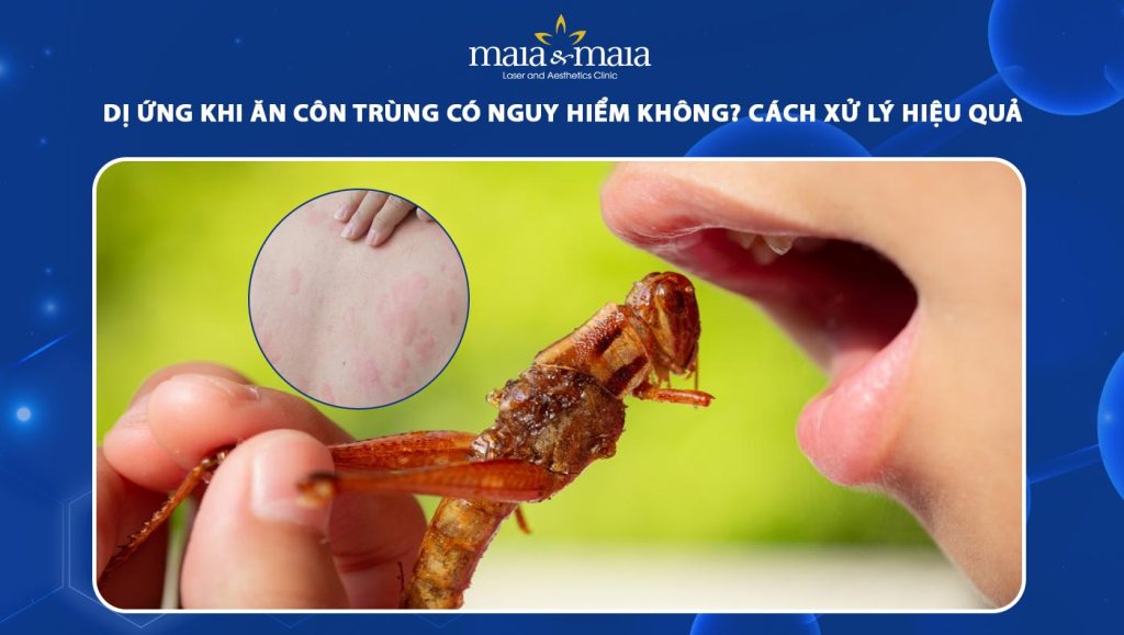 dị ứng khi ăn côn trùng
