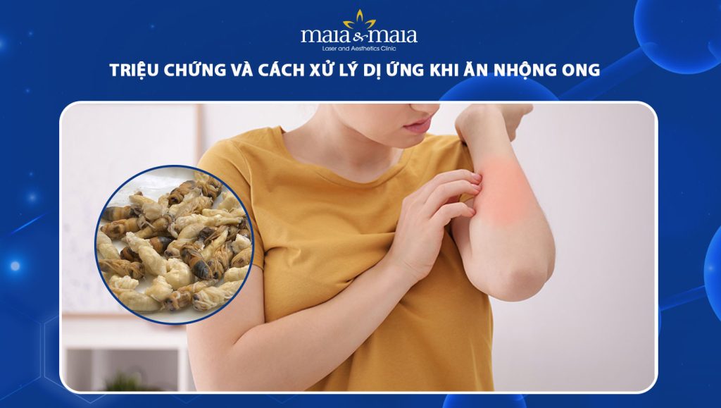 dị ứng khi ăn nhộng ong