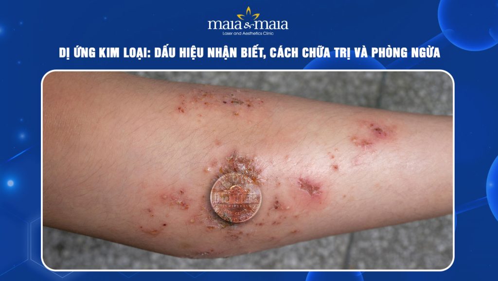 Dị ứng kim loại