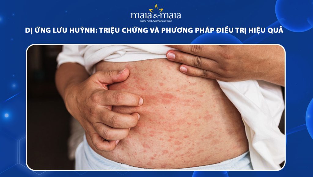 dị ứng lưu huỳnh