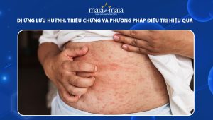 dị ứng lưu huỳnh