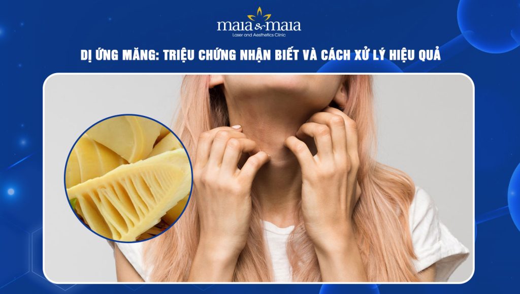 Dị ứng măng: Triệu chứng nhận biết và cách xử lý hiệu quả 1 Dị ứng măng
