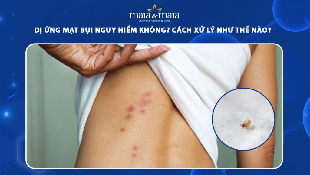 dị ứng mạt bụi