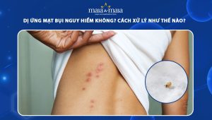 dị ứng mạt bụi