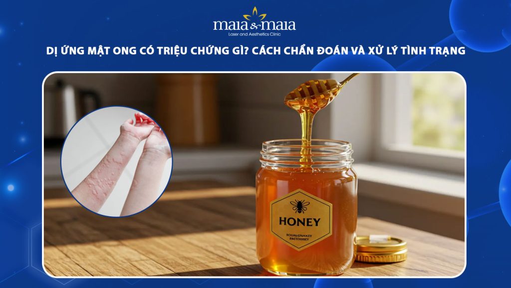 dị ứng mật ong