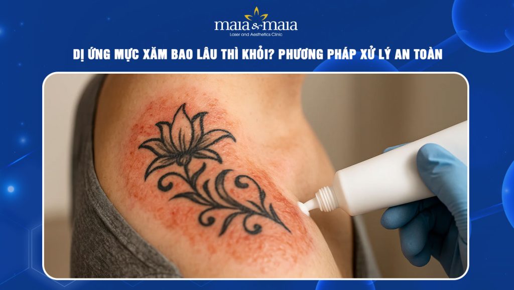 dị ứng mực xăm