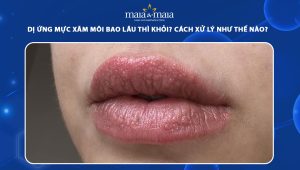 dị ứng mực xăm môi