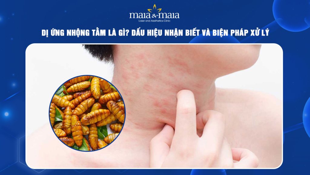 dị ứng nhộng tằm