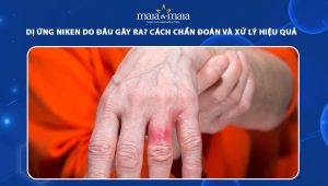 dị ứng niken