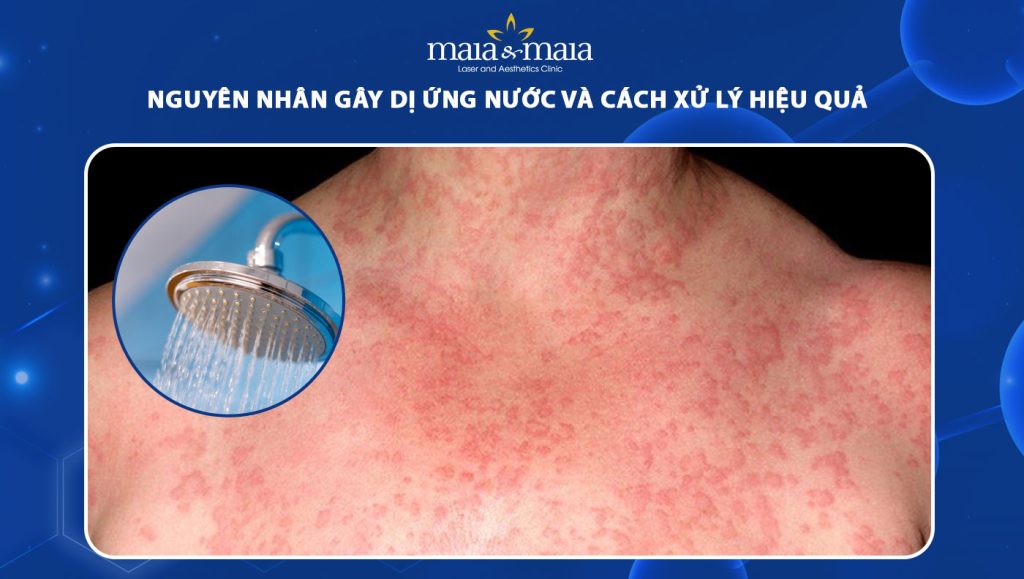 dị ứng nước