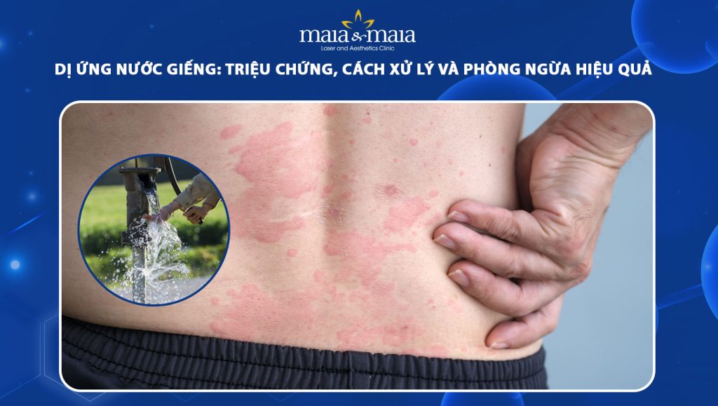 dị ứng nước giếng