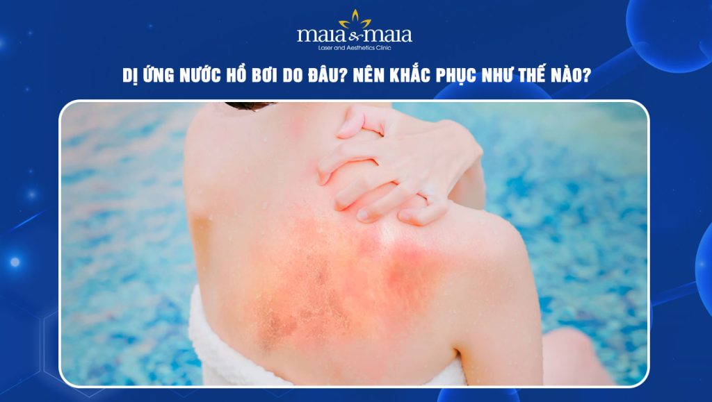 Dị ứng nước hồ bơi do đâu? Cách khắc phục như thế nào? 1 dị ứng nước hồ bơi