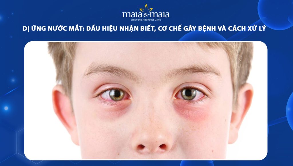 dị ứng nước mắt