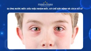 dị ứng nước mắt