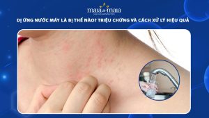 dị ứng nước máy