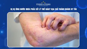 dị ứng nước mưa