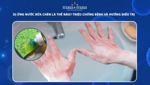dị ứng nước rửa chén
