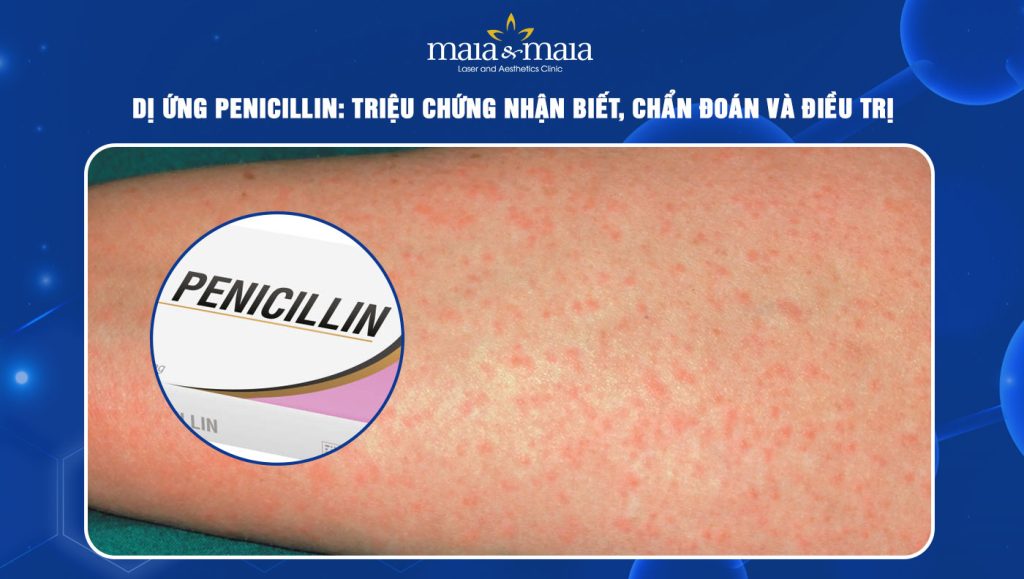 dị ứng Penicillin