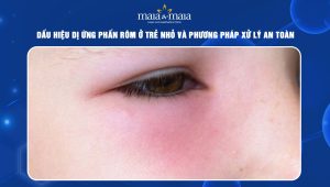 Dị ứng phấn rôm