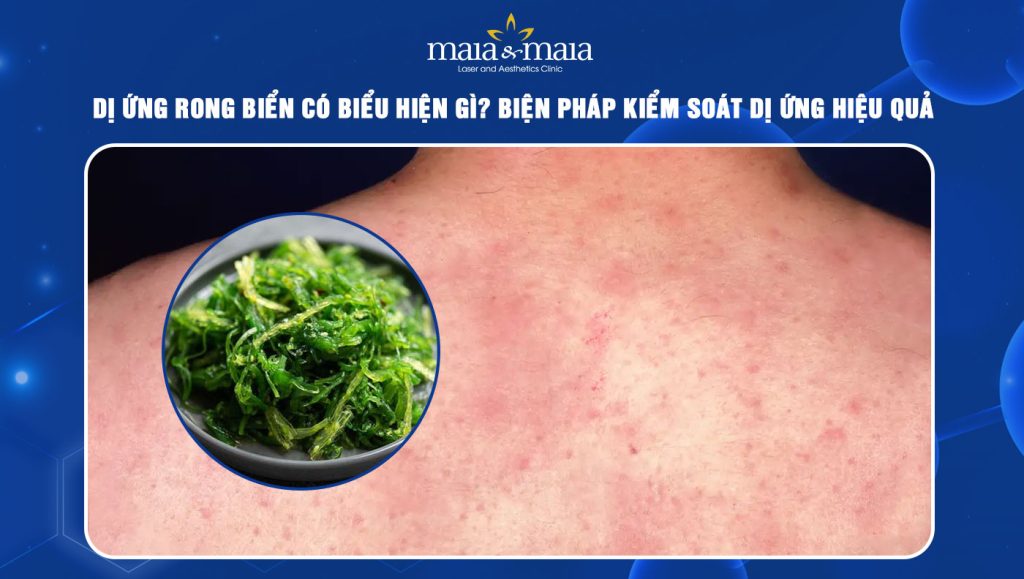 Dị ứng rong biển có biểu hiện gì? Biện pháp kiểm soát dị ứng 1 dị ứng rong biển
