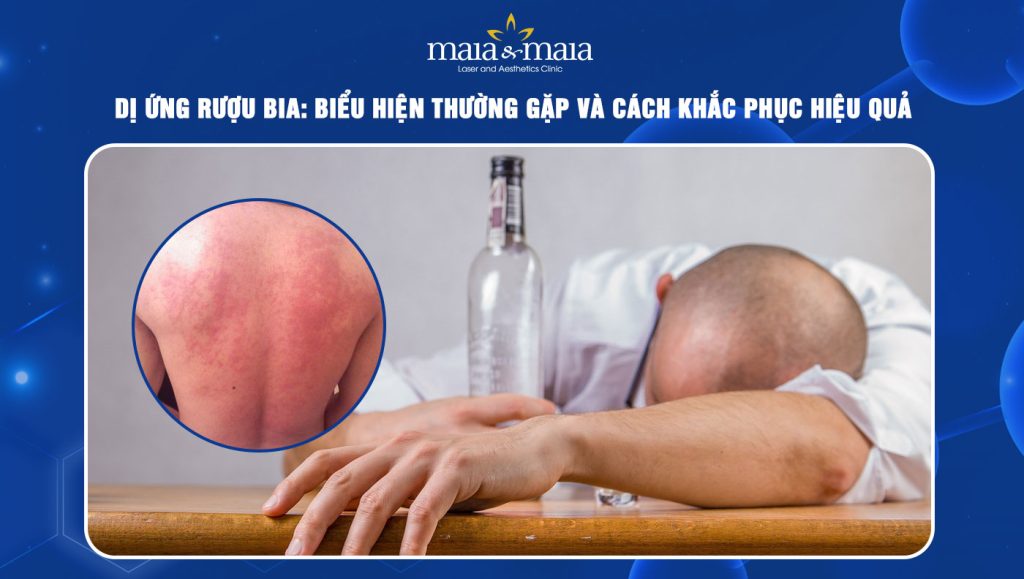 Dị ứng rượu bia