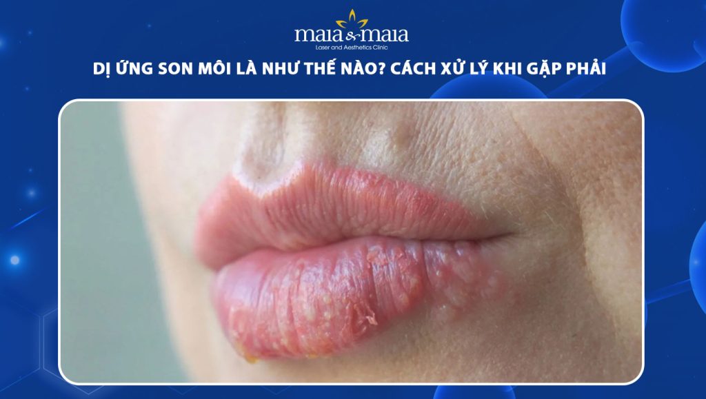 Dị ứng son môi là như thế nào? Cách xử lý khi gặp phải 1 dị ứng son môi