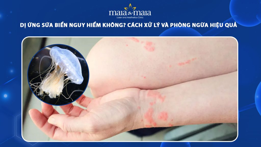 dị ứng sứa biển