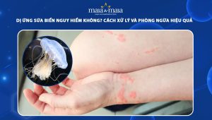 dị ứng sứa biển