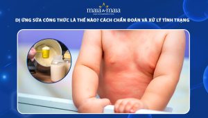 dị ứng sữa công thức