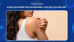 dị ứng sữa dưỡng thể