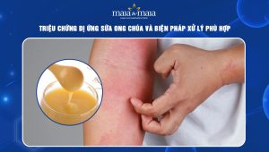 dị ứng sữa ong chúa