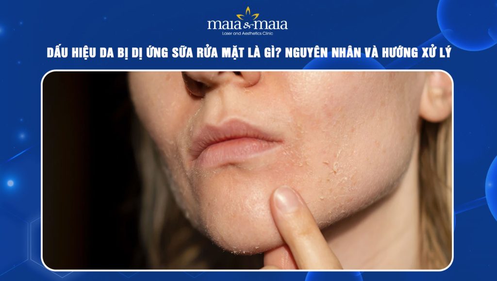 dị ứng sữa rửa mặt