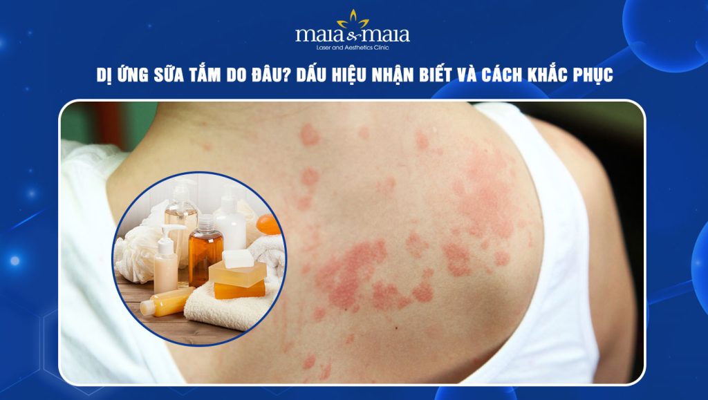 Dị ứng sữa tắm do đâu? Dấu hiệu nhận biết và cách khắc phục 1 dị ứng sữa tắm