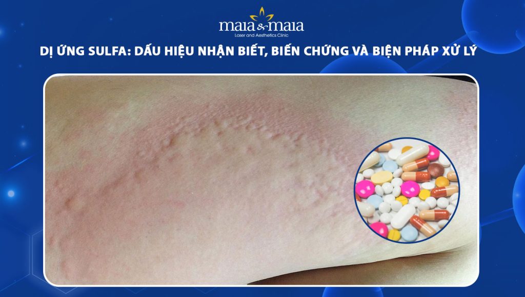 dị ứng sulfa