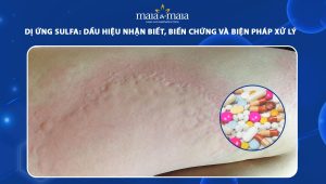 dị ứng sulfa