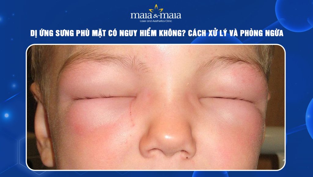 dị ứng sưng phù mặt