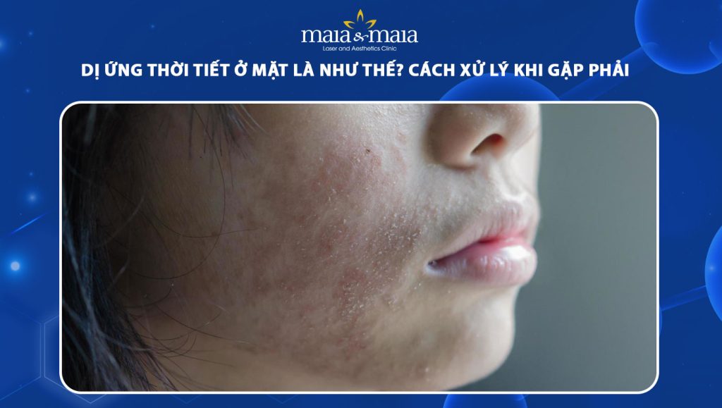 dị ứng thời tiết ở mặt