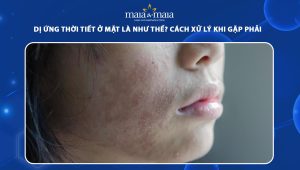 dị ứng thời tiết ở mặt