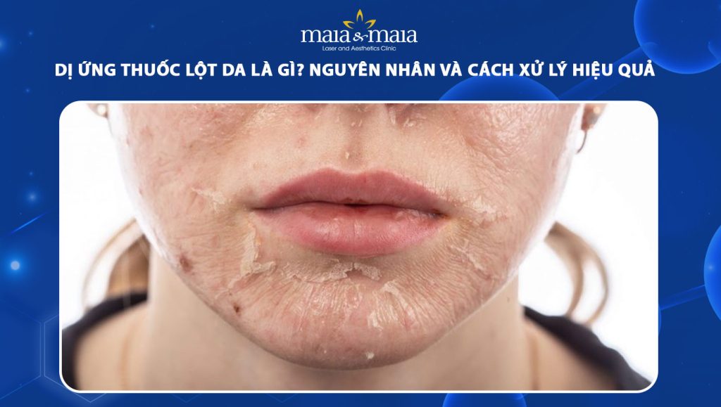 dị ứng thuốc lột da