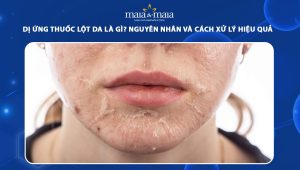 dị ứng thuốc lột da