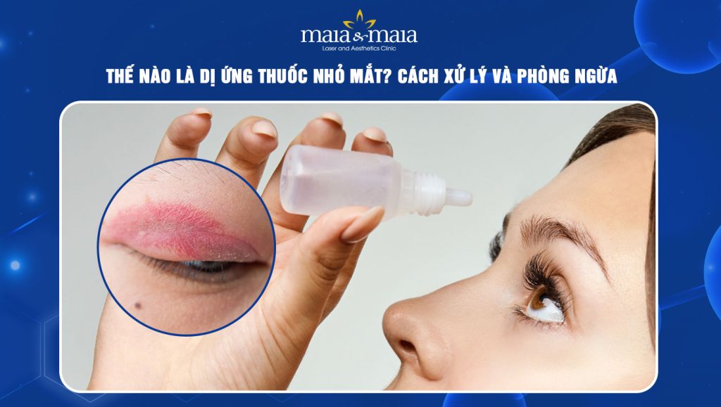 Thế nào là dị ứng thuốc nhỏ mắt? Cách xử lý và phòng ngừa 1 Dị ứng thuốc nhỏ mắt